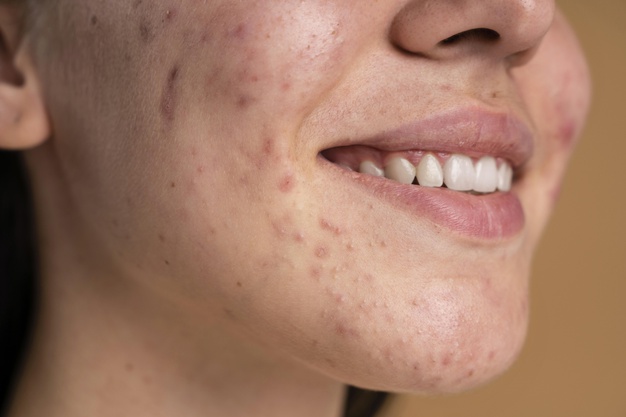 confident young woman with acne close up 23 2148982536